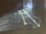 Subtalar joint fusion as a result of a solo fall