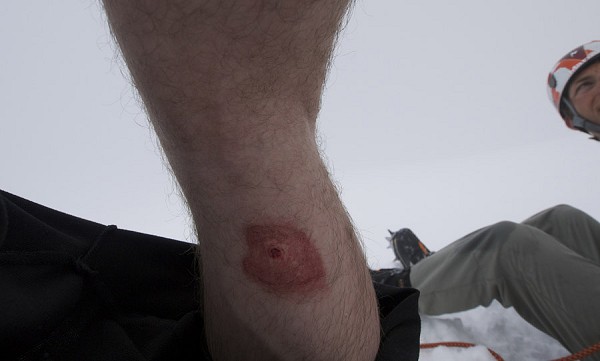 The crampon hole in Jon's leg! Ouch!  © Jon Griffith / Alpine Exposures