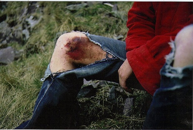 John Syrett's knee after an ascent of Post Mortem,Eagle Crag ,Borrowdale. 1974  © USBRIT