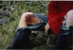 John Syrett's knee after an ascent of Post Mortem,Eagle Crag ,Borrowdale. 1974