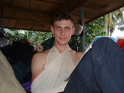 Me with a disclocated shoulder after a fall climbing at Chehunie Java