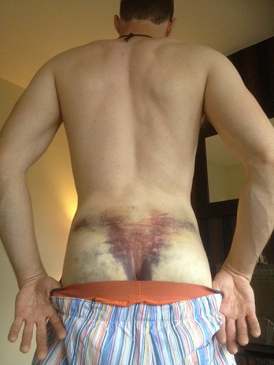 My back after decking out.  Sledge hammer to the spine was how it felt   © Lukeva