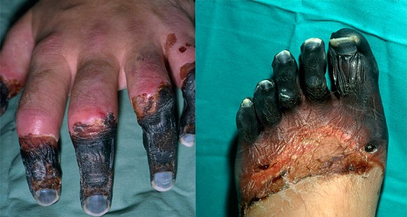Nigel Vardys hands and feet after the accident  © Summit Financial Services