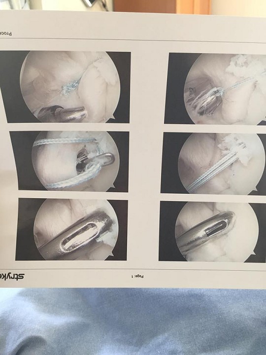 Images of Hazel's shoulder surgery in action  © Hazel Findlay