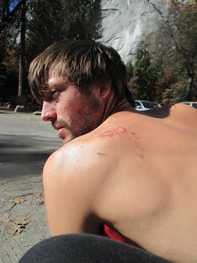 Ryan's scars after the Monster Offwidth  © Maddie Cope