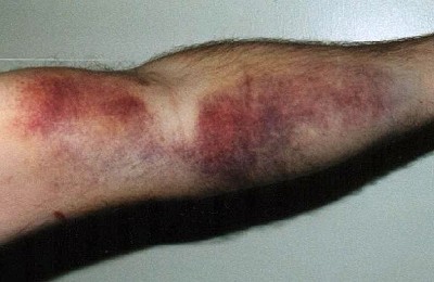 Bruise after falling off indoors....  © Chris Harris