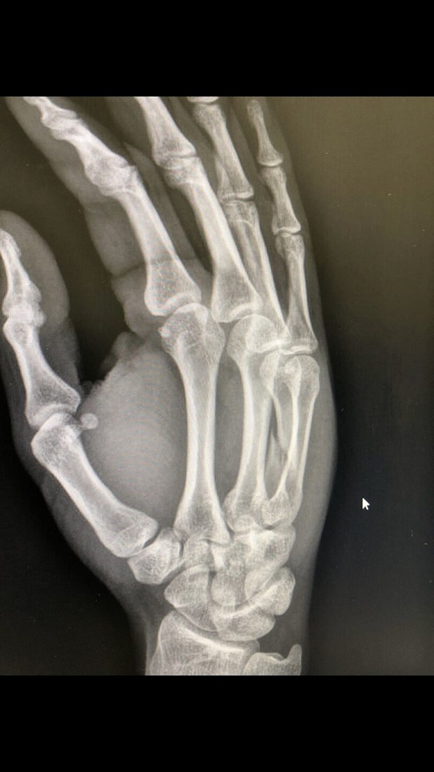 A 4th metacarpal fracture, caused by hitting a hold on a dynamic move.  © Cristiano Costa da Silva