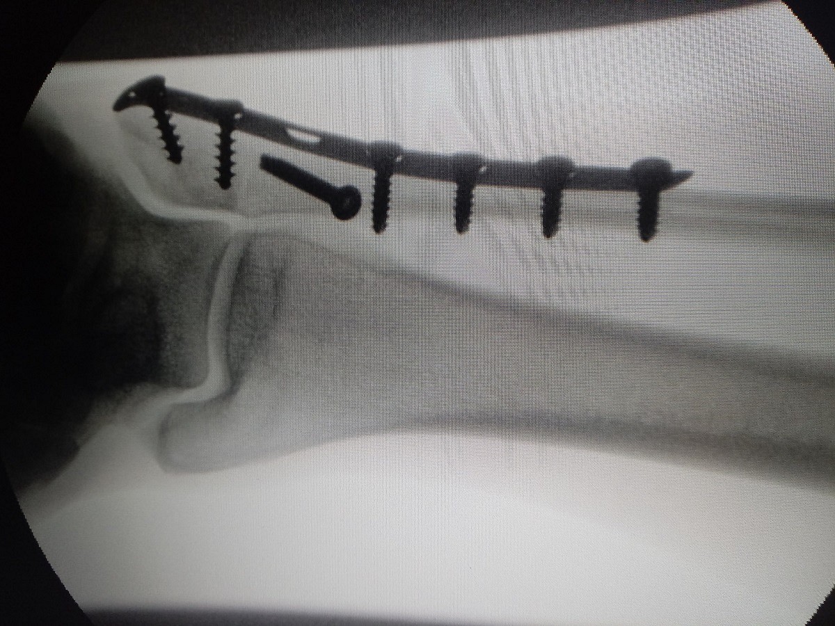 Ankle fixings: it's going to be a long recovery  © Gail Donaldson