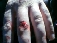 Matt's hand after an interesting incident at the climbing wall!